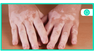 Best Cannabis Strains for Autoimmune Disease Natural Relief
