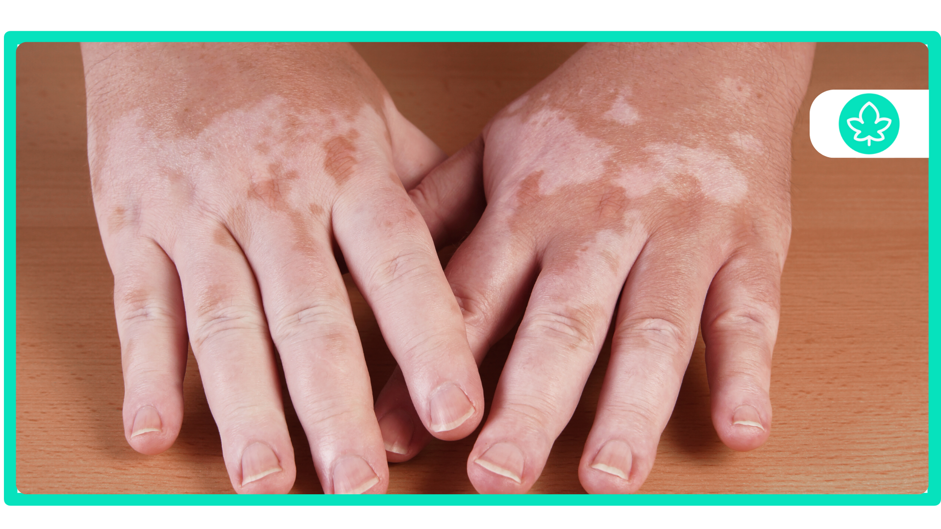 Best Cannabis Strains for Autoimmune Disease Natural Relief